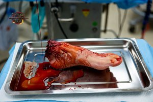 Amputated Leg in Surgery