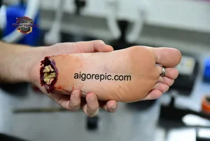 Severe Foot Injury Close-Up