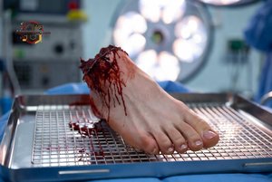 Severed Foot in Surgery
