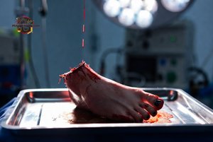 Severed Foot in Surgery