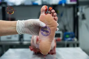 Severed Foot in Surgery