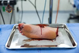 Severed Human Foot