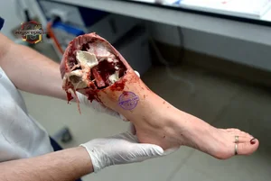 Severed Leg in Autopsy