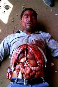 Man with Severe Injury