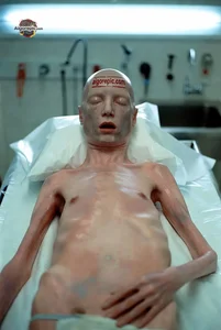 Emaciated Body on Autopsy Table